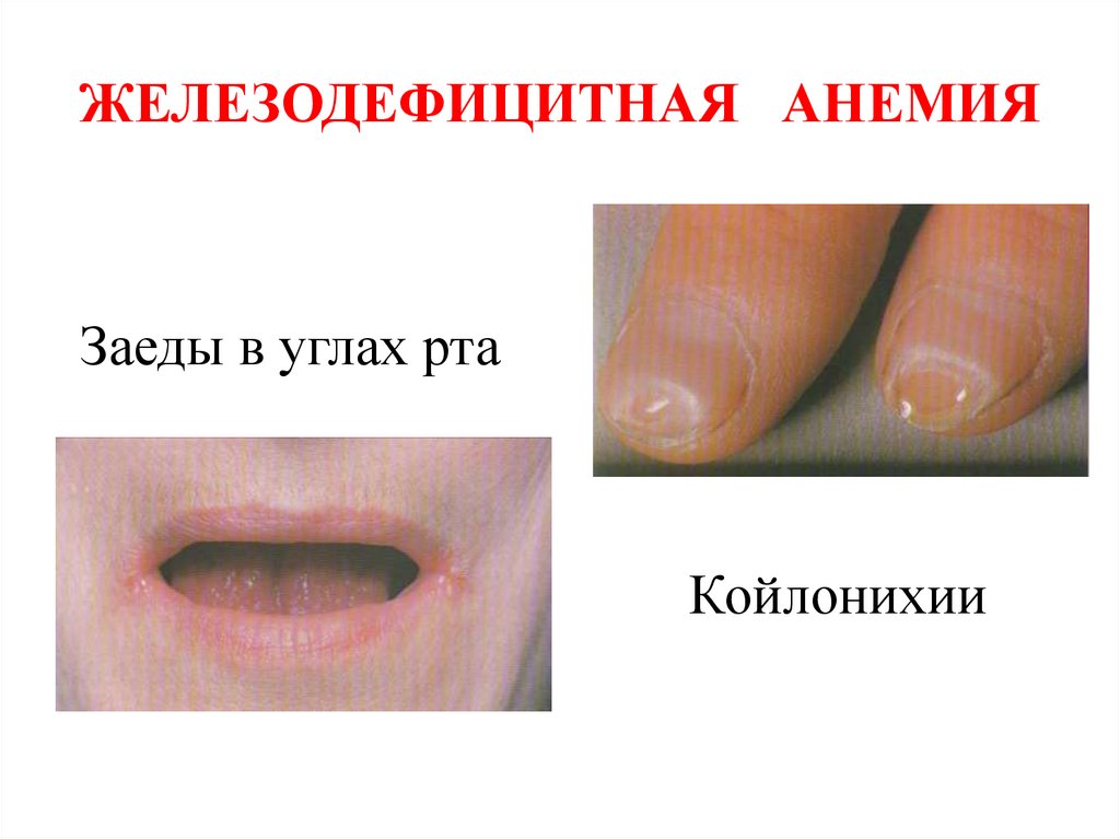 ЖЕЛЕЗОДЕФИЦИТНАЯ АНЕМИЯ