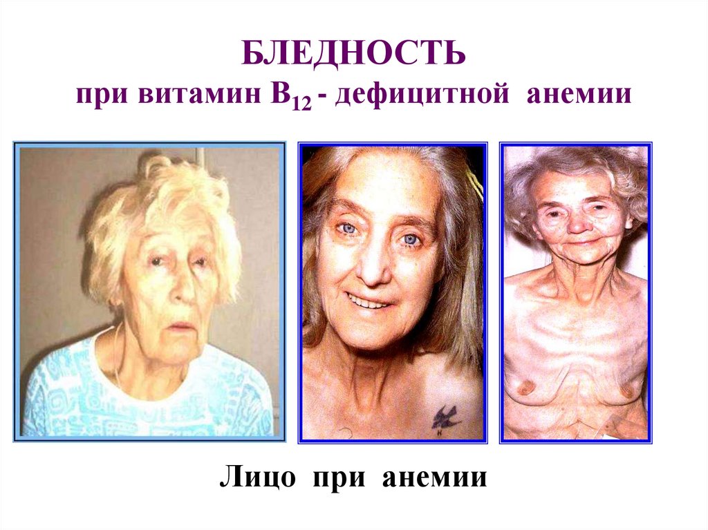 Лицо при анемии