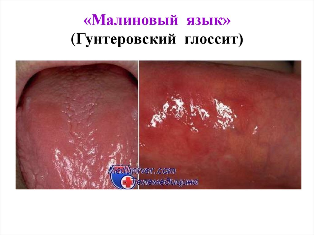 «Малиновый язык» (Гунтеровский глоссит)