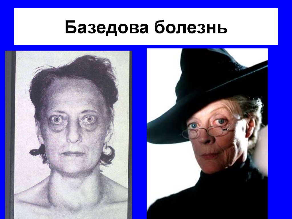 Базедова болезнь