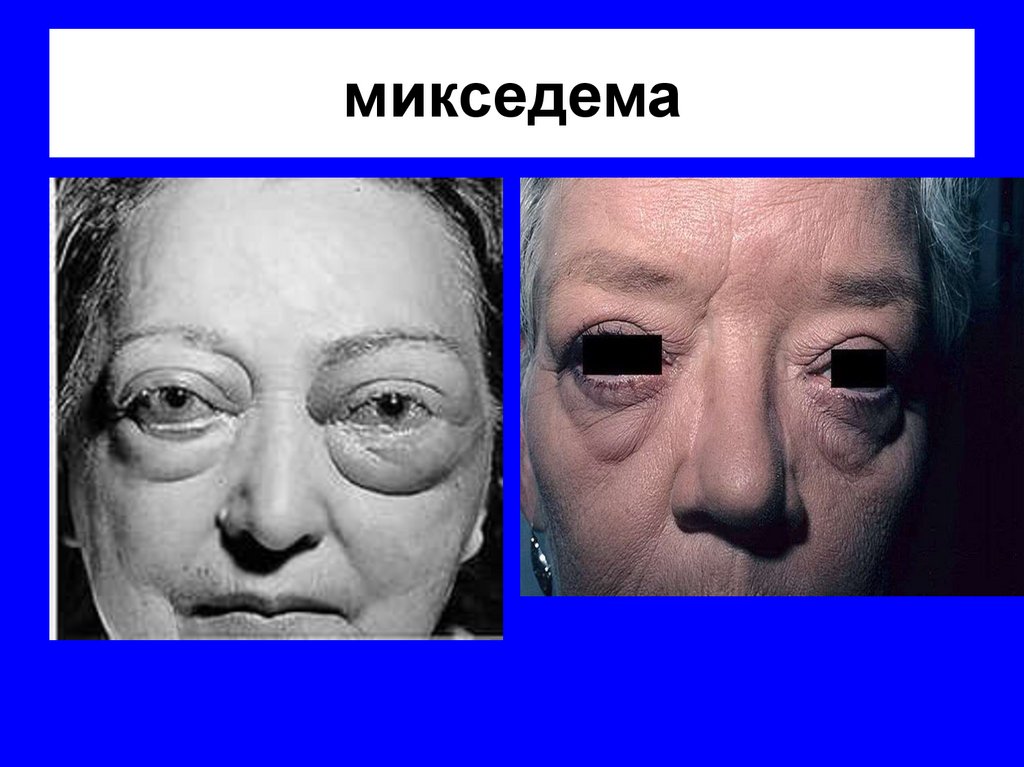 микседема