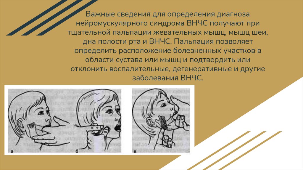 Важные сведения для определения диагноза нейромускулярного синдрома ВНЧС получают при тщательной пальпации жевательных мышц,