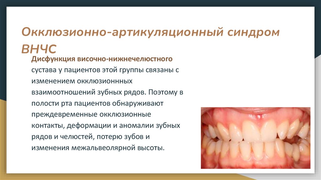 Окклюзионно-артикуляционный синдром ВНЧС