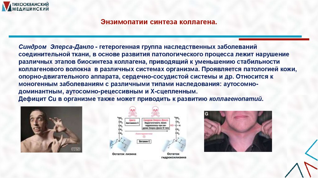 Энзимопатии синтеза коллагена.