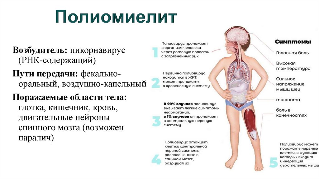 Полиомиелит