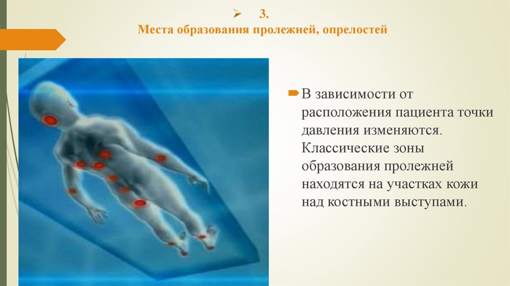 3. Места образования пролежней, опрелостей