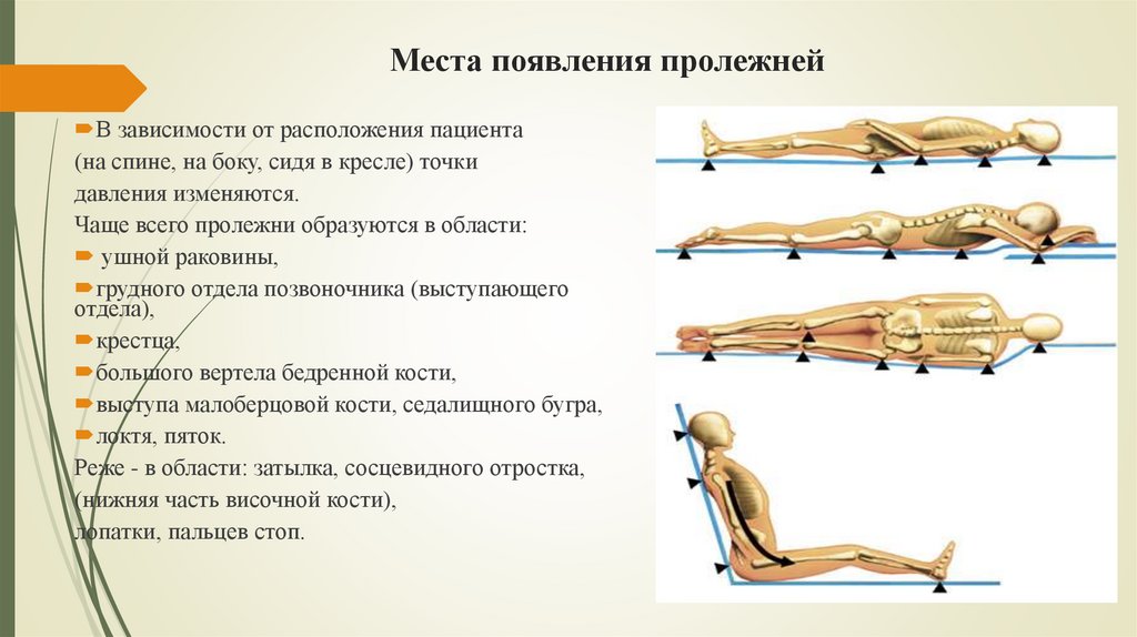 Места появления пролежней