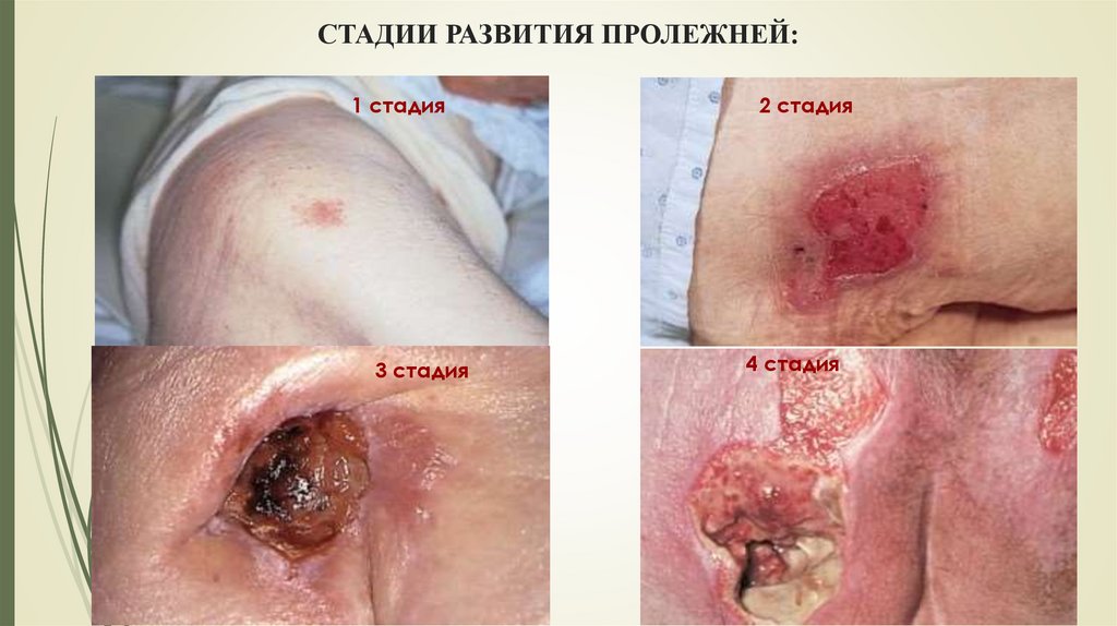 СТАДИИ РАЗВИТИЯ ПРОЛЕЖНЕЙ:
