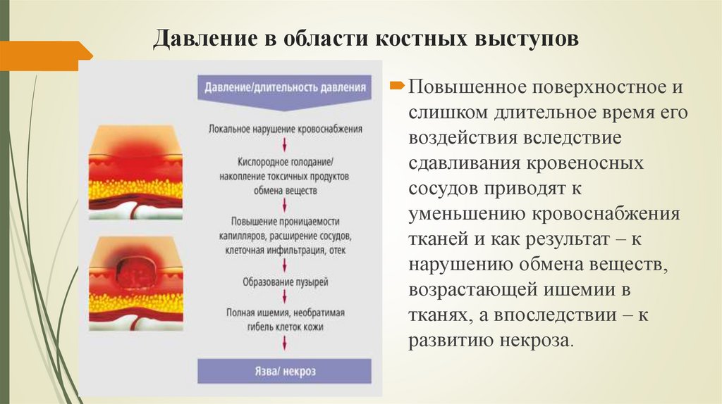 Давление в области костных выступов
