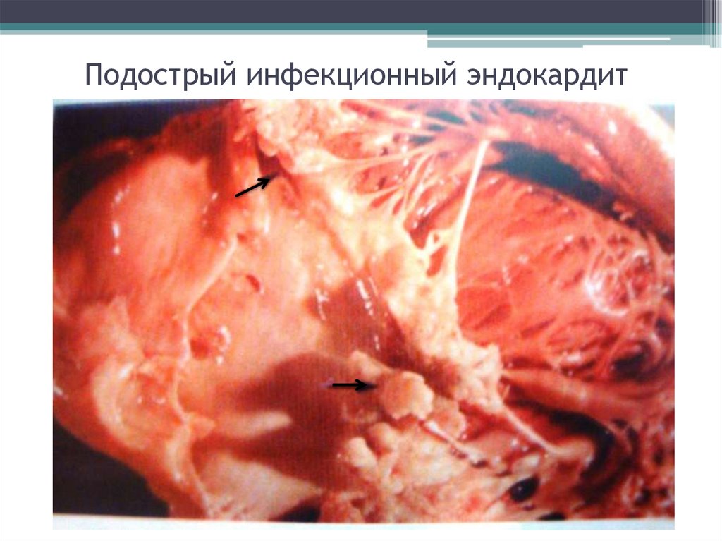 Подострый инфекционный эндокардит