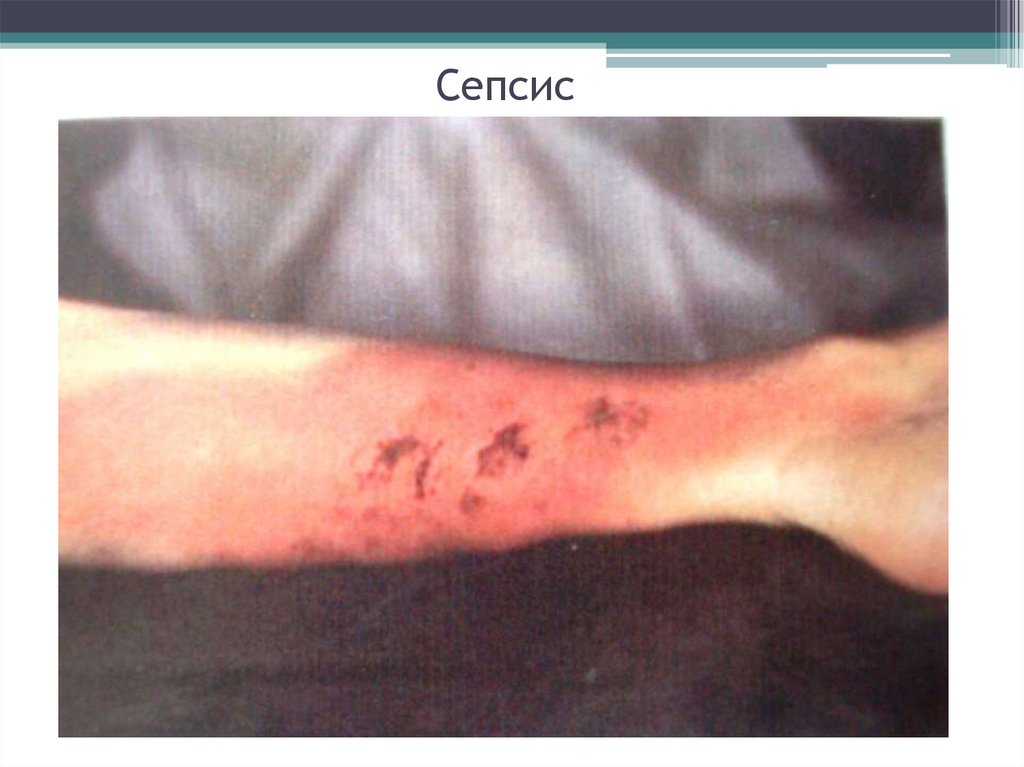 Сепсис