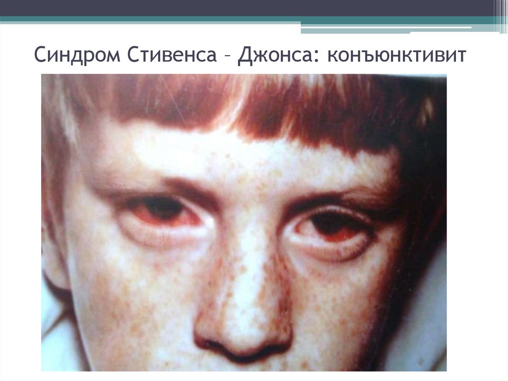 Синдром Стивенса – Джонса: конъюнктивит