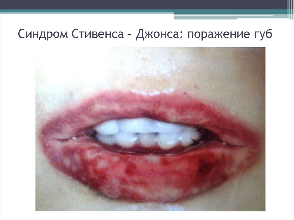 Синдром Стивенса – Джонса: поражение губ