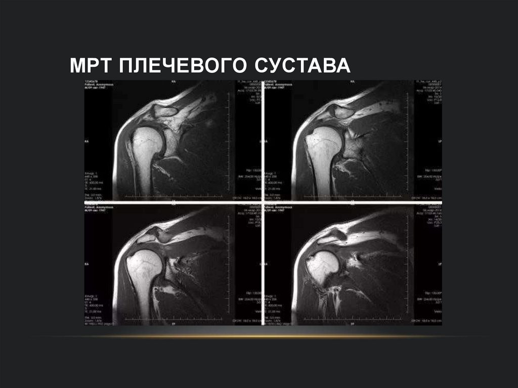 МРТ плечевого сустава