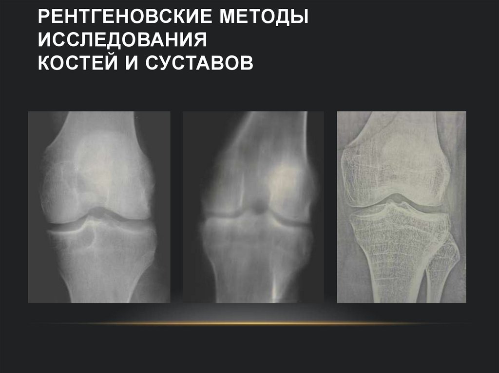 Рентгеновские методы исследования костей и суставов