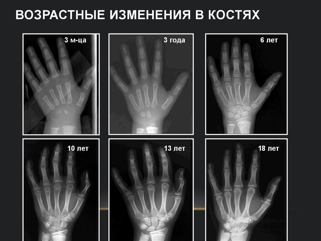 Возрастные изменения в костях