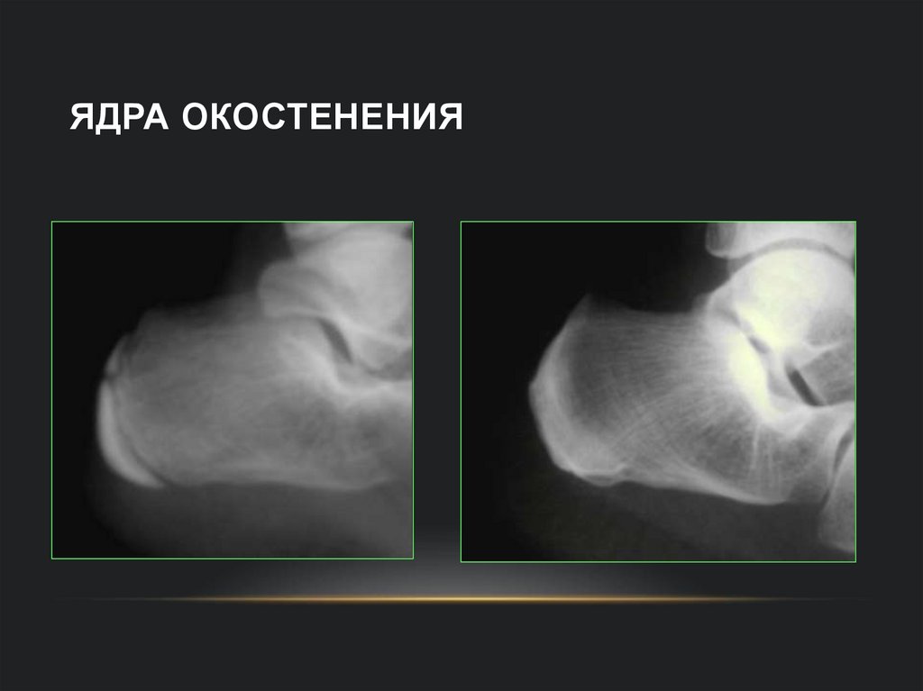 Ядра окостенения