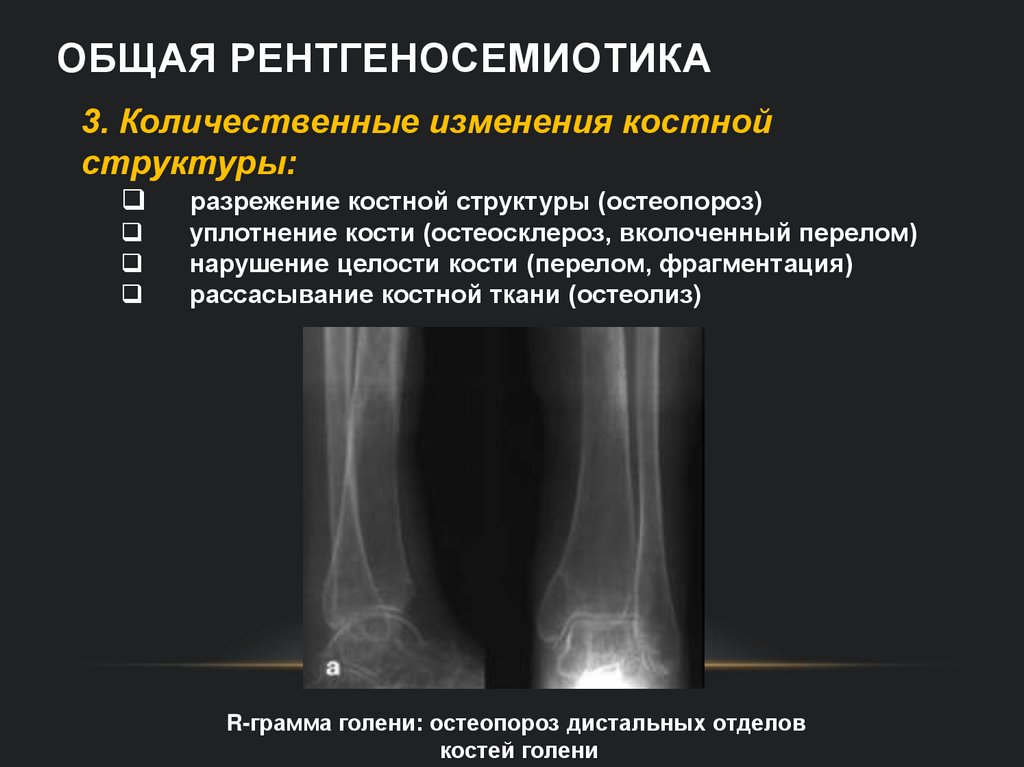 Общая рентгеносемиотика