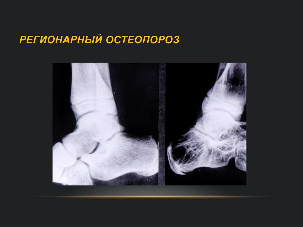 Регионарный остеопороз