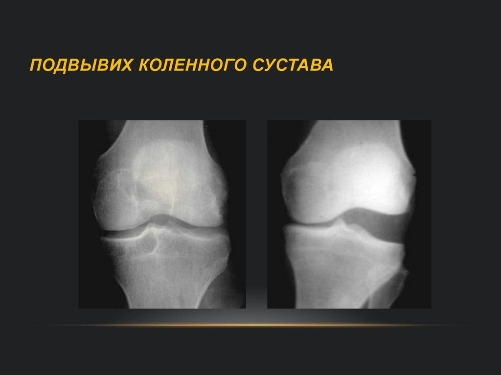 Подвывих коленного сустава