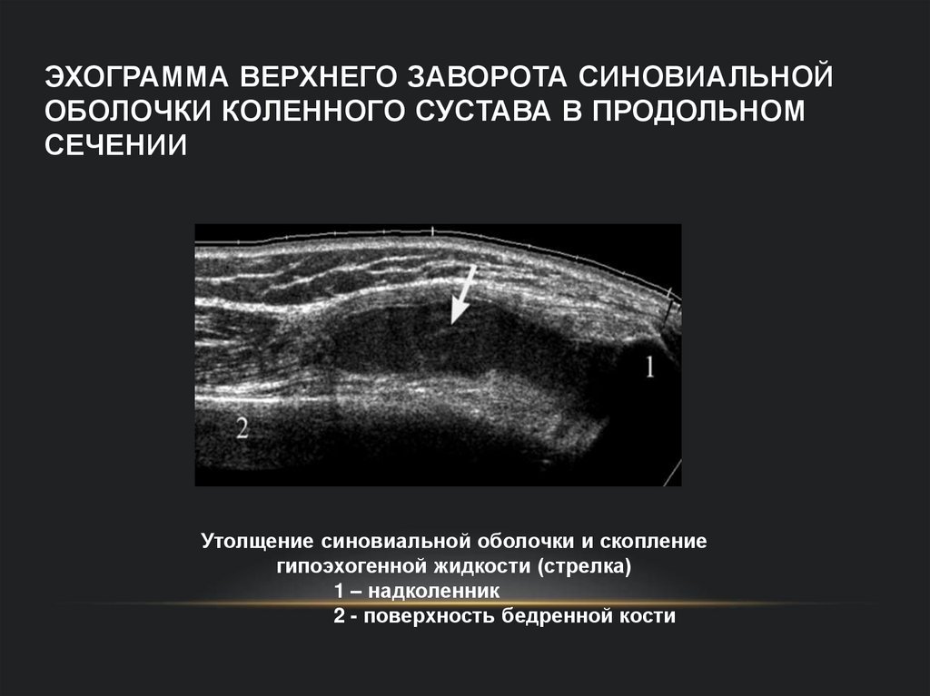Эхограмма верхнего заворота синовиальной оболочки коленного сустава в продольном сечении