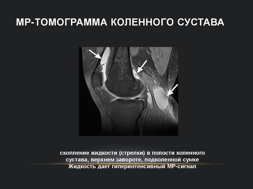 МР-томограмма коленного сустава