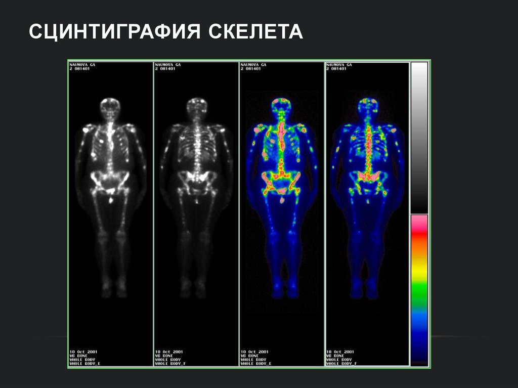 Сцинтиграфия скелета