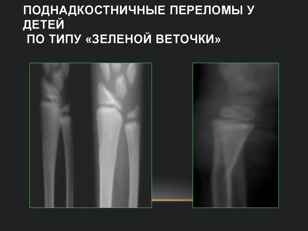 Поднадкостничные переломы у детей по типу «зеленой веточки»