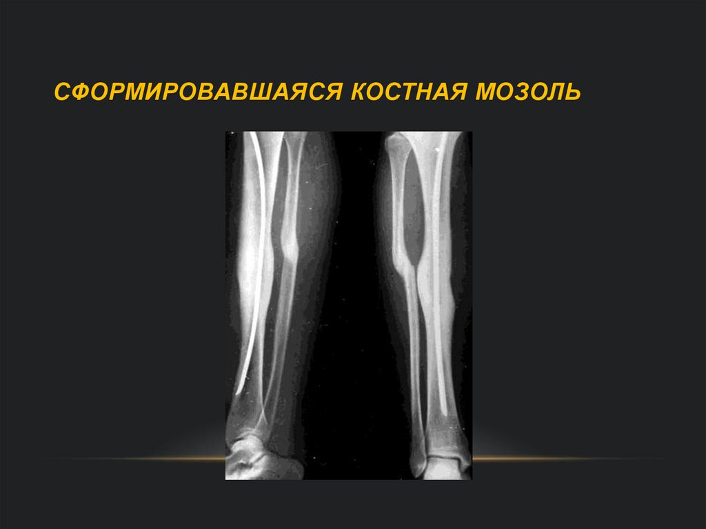 Сформировавшаяся костная мозоль