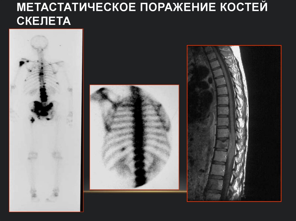 Метастатическое поражение костей скелета