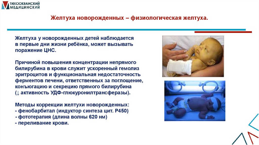Желтуха новорожденных – физиологическая желтуха.