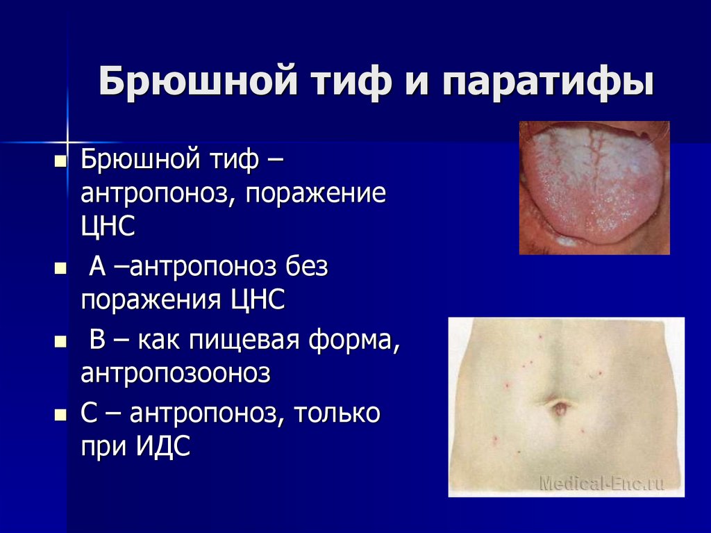 Брюшной тиф и паратифы