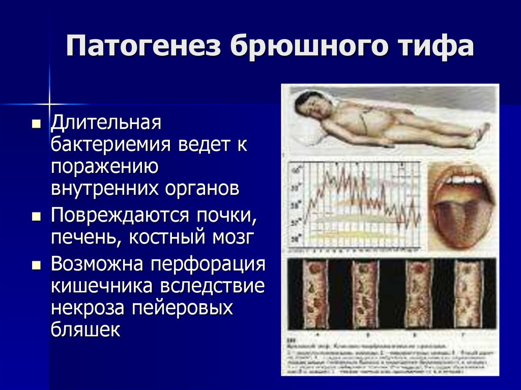 Патогенез брюшного тифа
