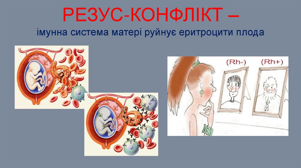 Резус-конфлікт – імунна система матері руйнує еритроцити плода