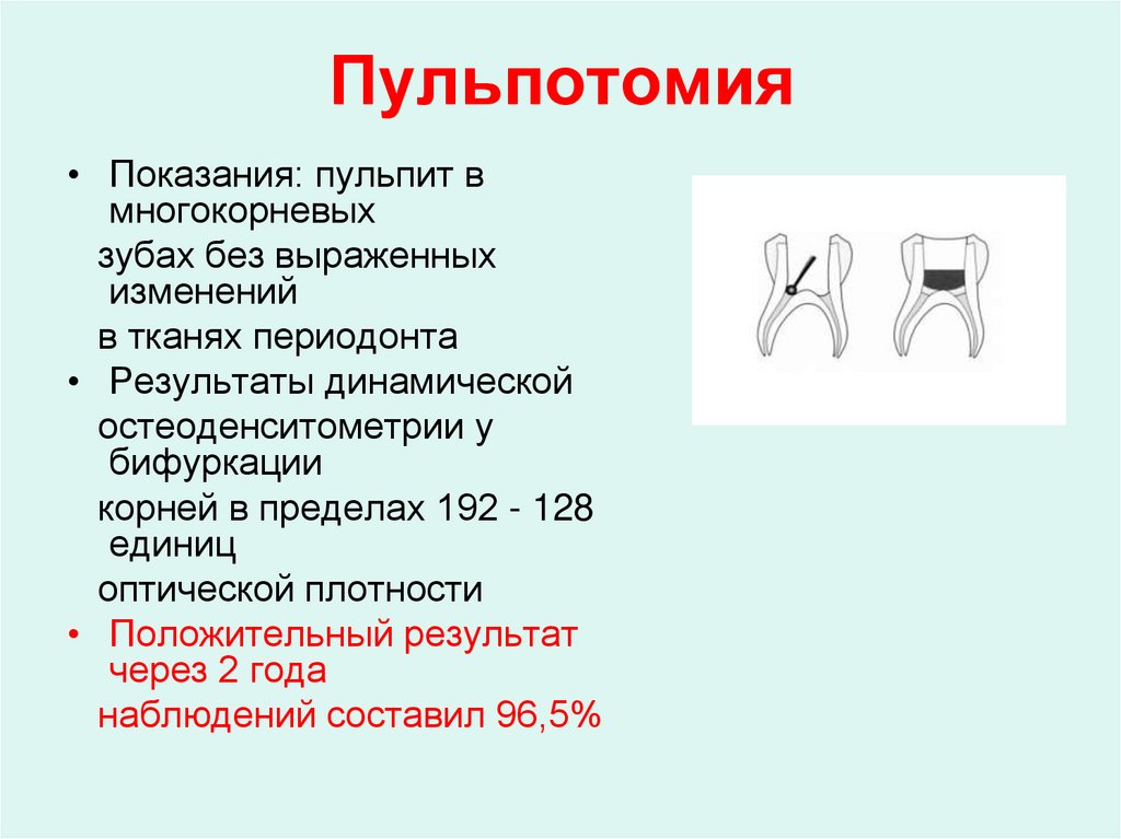 Пульпотомия