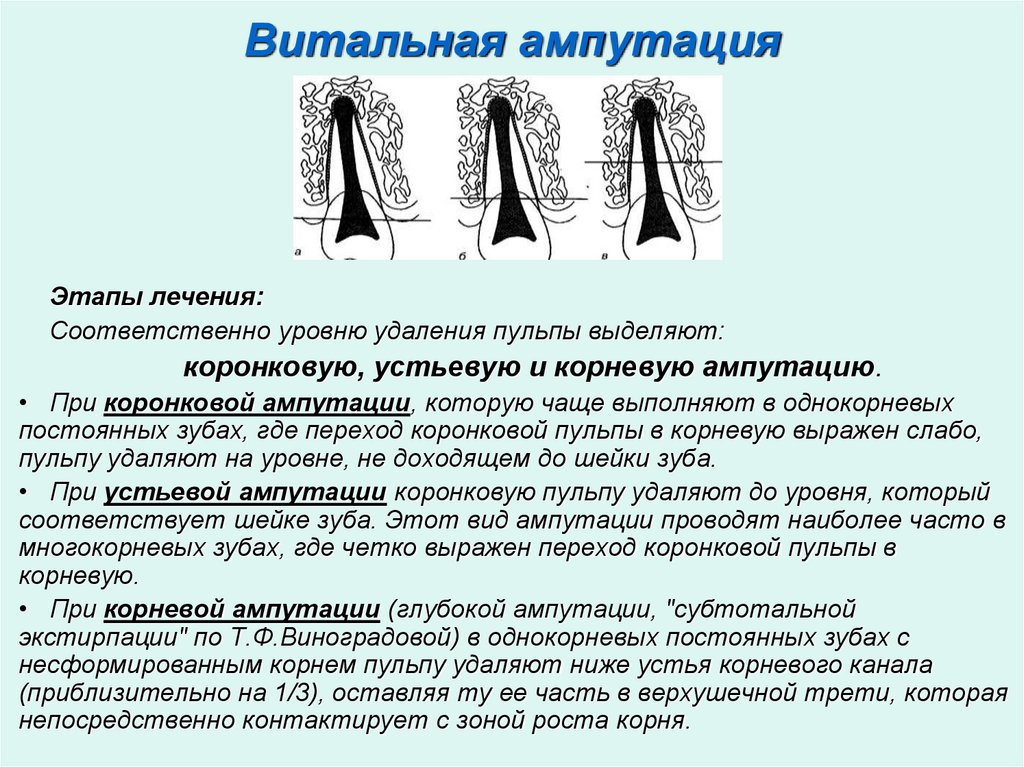 Витальная ампутация