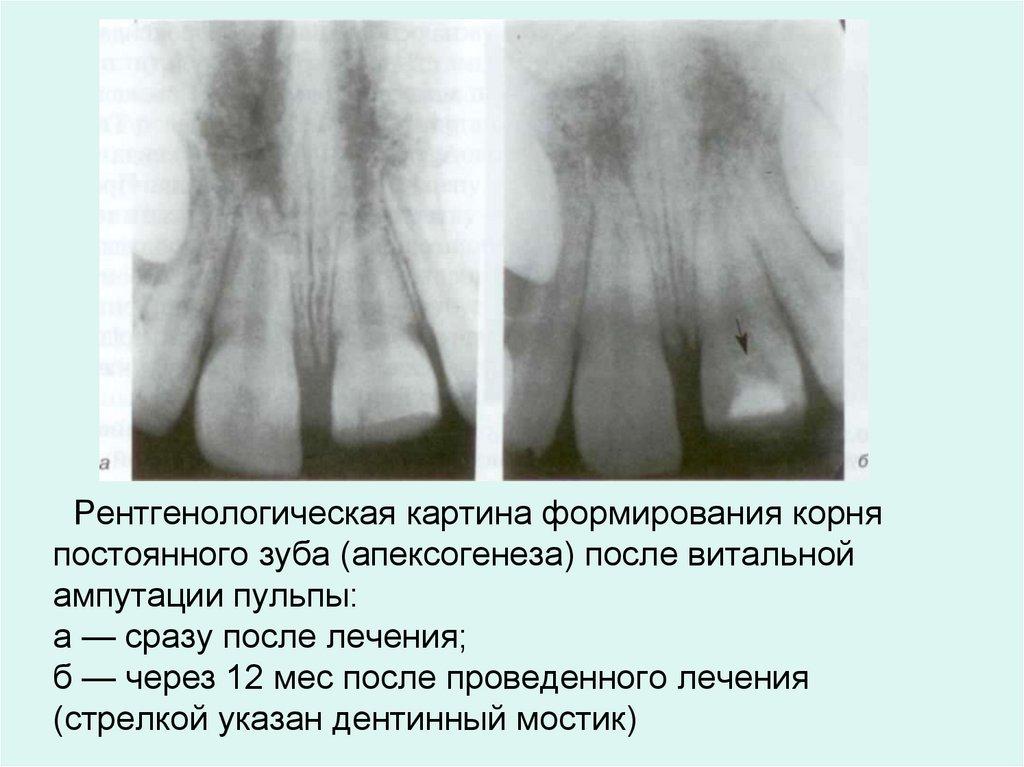 Рентгенологическая картина формирования корня постоянного зуба (апексогенеза) после витальной ампутации пульпы: а — сразу после