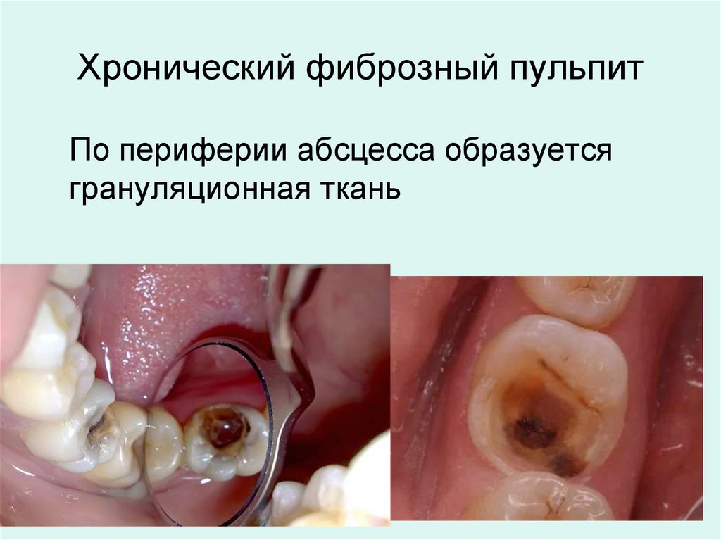 Хронический фиброзный пульпит