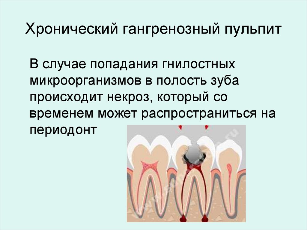 Хронический гангренозный пульпит