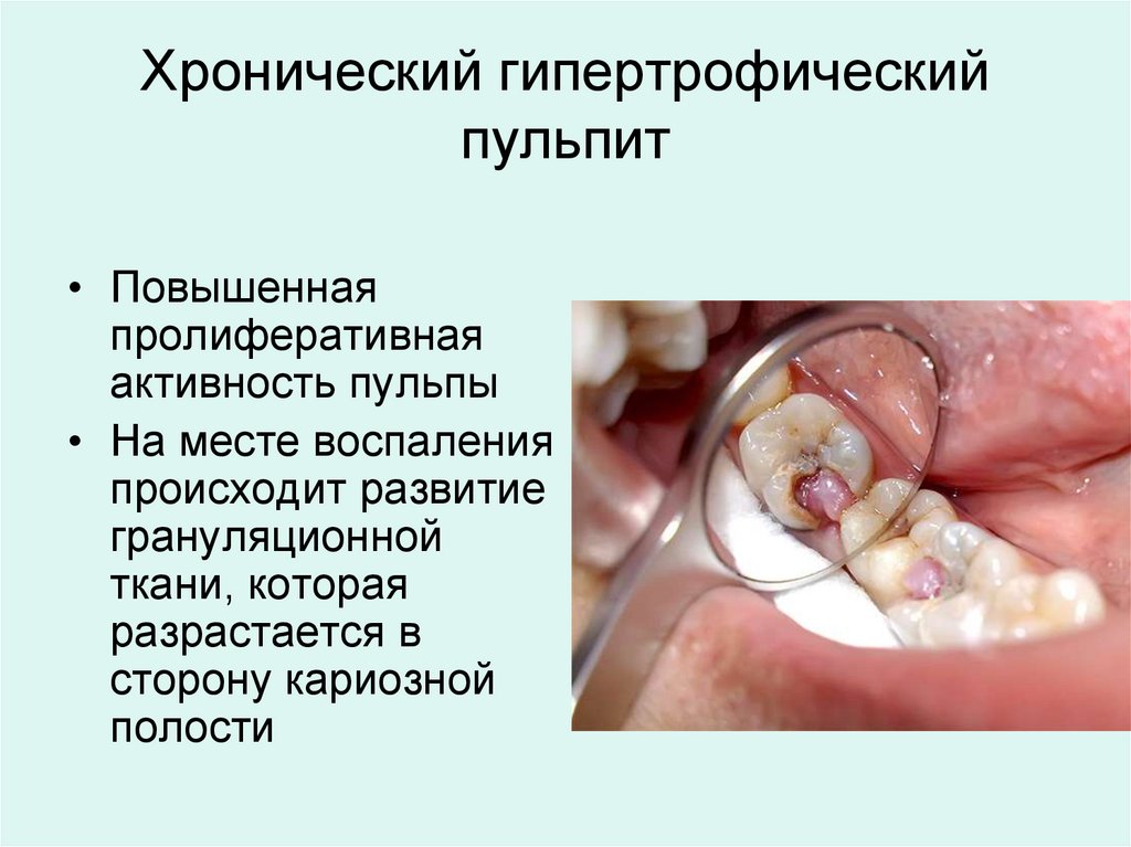 Хронический гипертрофический пульпит