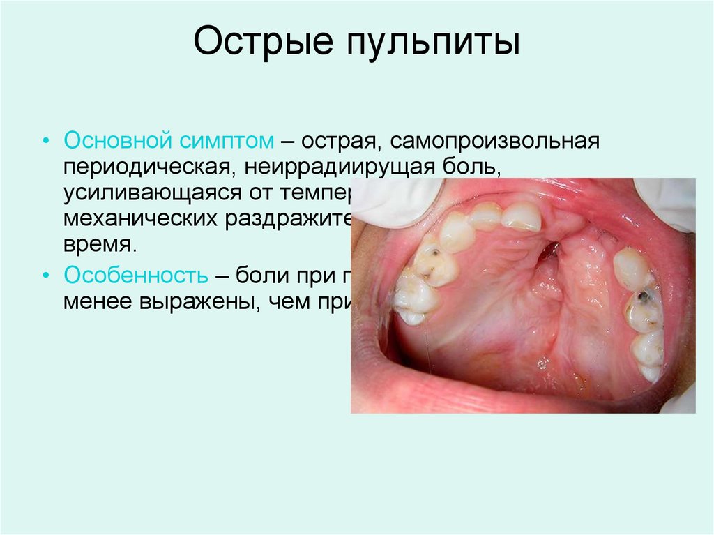 Острые пульпиты