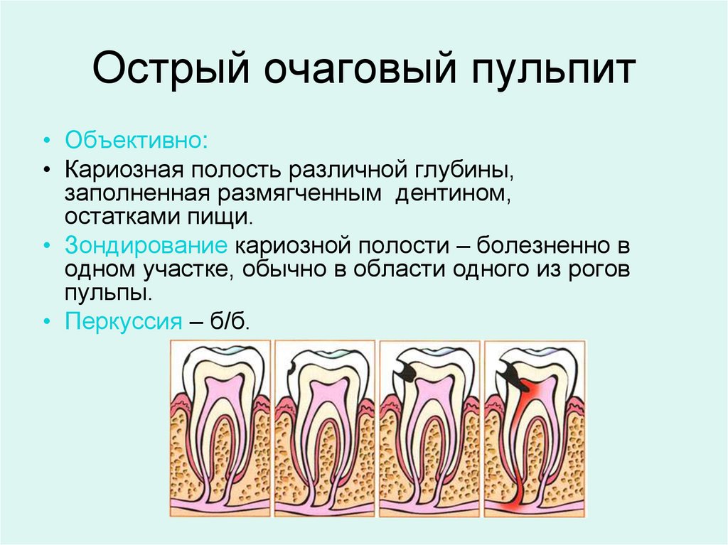 Острый очаговый пульпит