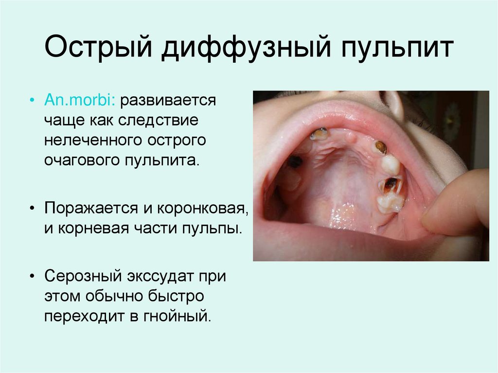 Острый диффузный пульпит