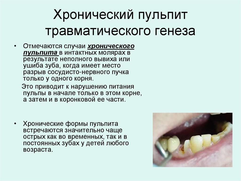 Хронический пульпит травматического генеза