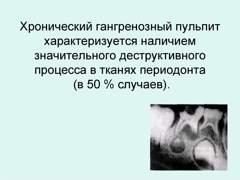 Хронический гангренозный пульпит характеризуется наличием значительного деструктивного процесса в тканях периодонта (в 50 %