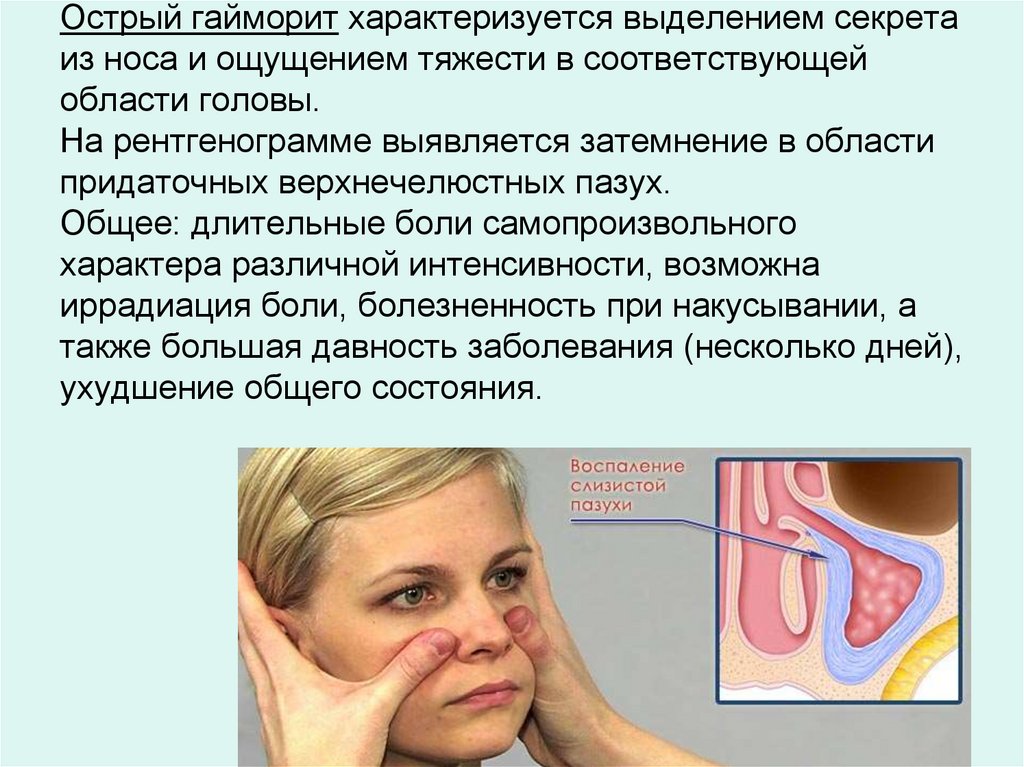 Острый гайморит характеризуется выделением секрета из носа и ощущением тяжести в соответствующей области головы. На