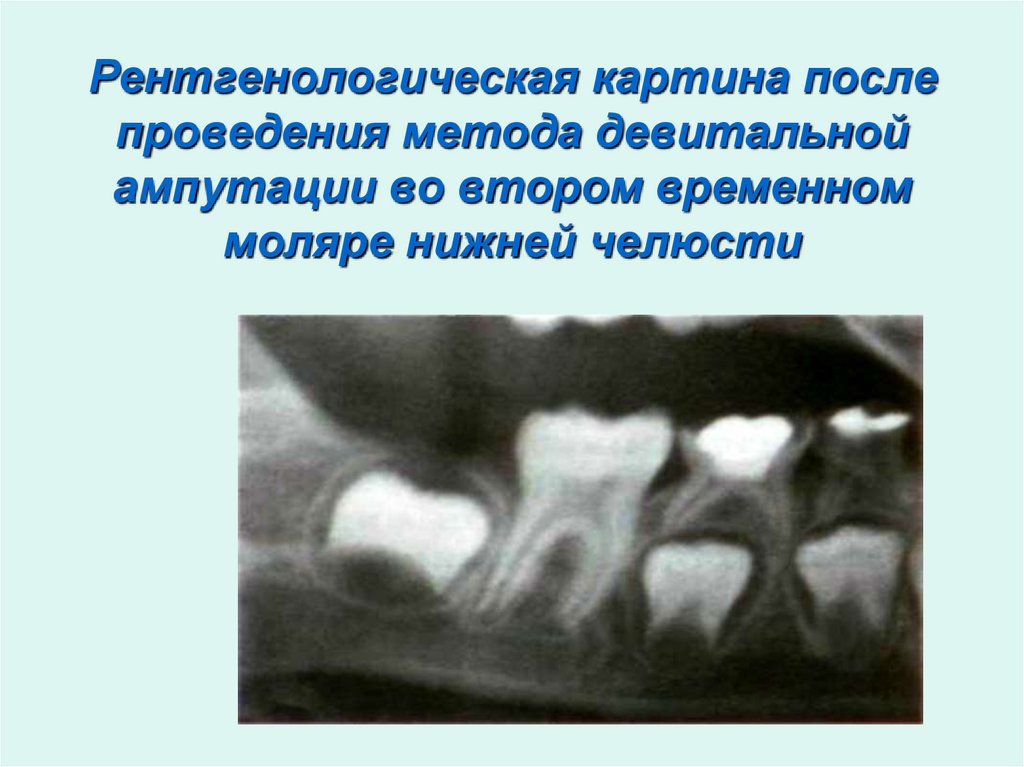Рентгенологическая картина после проведения метода девитальной ампутации во втором временном моляре нижней челюсти