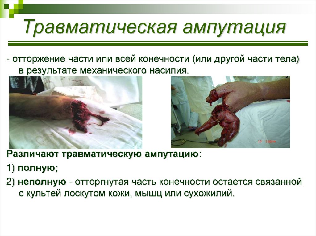Травматическая ампутация