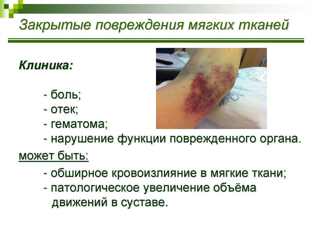 Закрытые повреждения мягких тканей