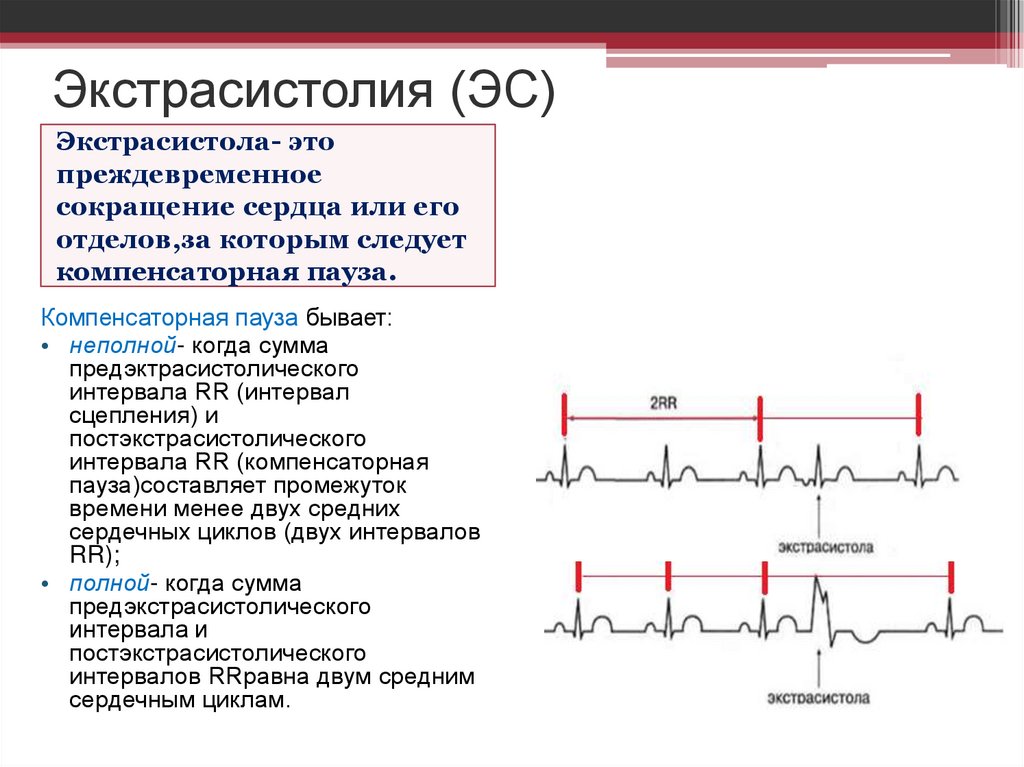 Экстрасистолия (ЭС)